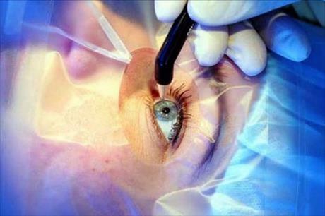 laser o�i